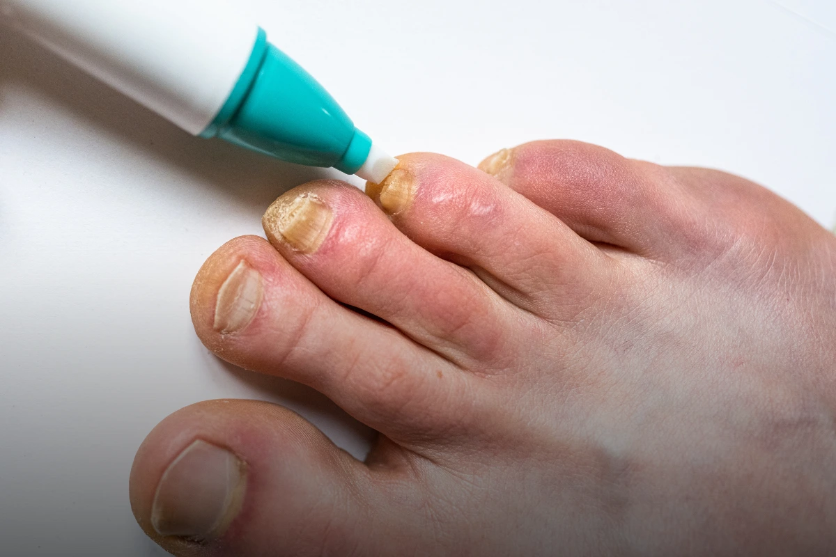 Skin and Nail Biopsy procedure at Taara Skin and Hair Clinic